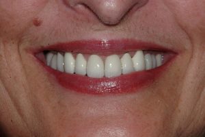 Patient 8: after