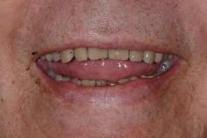 Patient 4: before