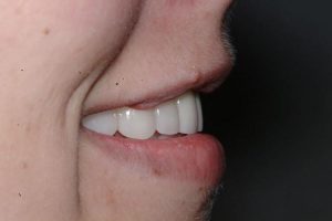 Patient 2: after