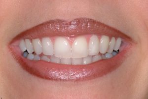 Patient 3: after